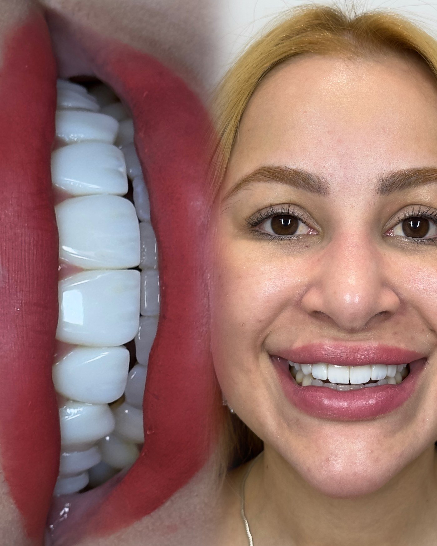 Detalhes do caso em destaque com lentes em resina